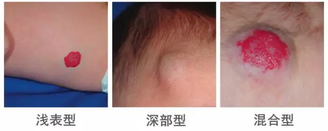 血管瘤区别，昆明血管瘤区别