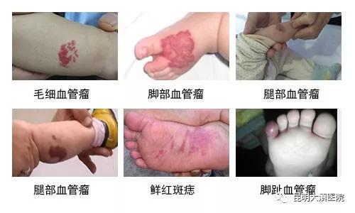 婴幼儿血管瘤，昆明治疗婴幼儿血管瘤误区，孩子治疗血管瘤时间