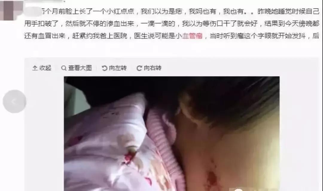 红点是血管瘤吗，血管瘤什么样子，孩子血管瘤