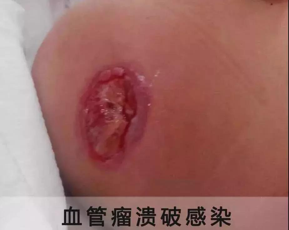 血管瘤溃烂，血管瘤溃烂护理，孩子血管瘤破烂
