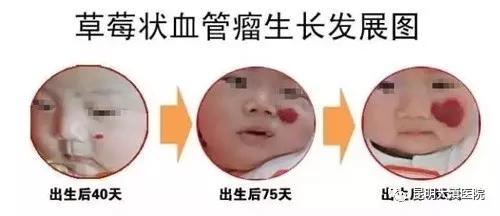 草莓状血管瘤图片
