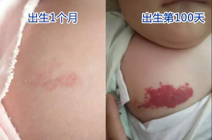 血管瘤危害，昆明治疗血管瘤
