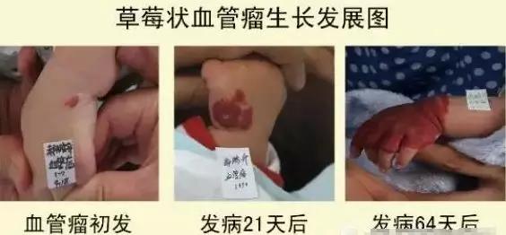 草莓状血管瘤