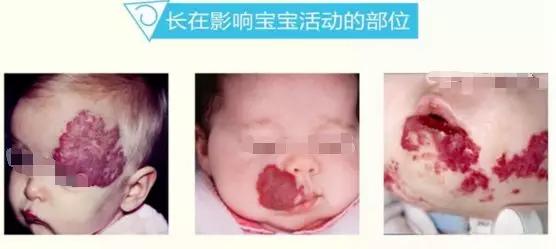 婴幼儿血管瘤早治疗