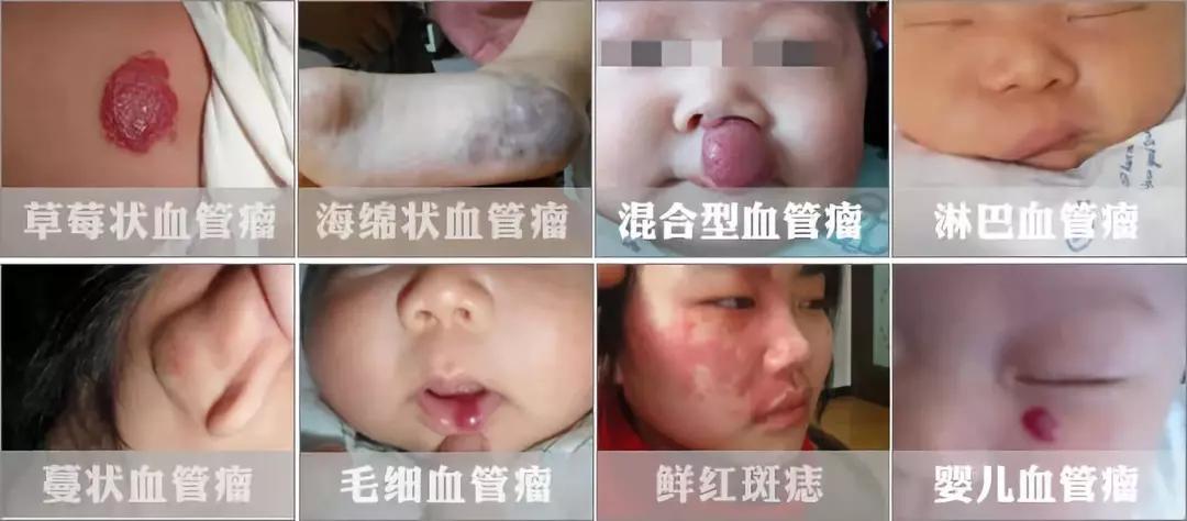 昆明如何确诊血管瘤，血管瘤检查