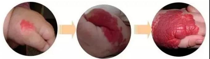 为什么血管瘤要治疗