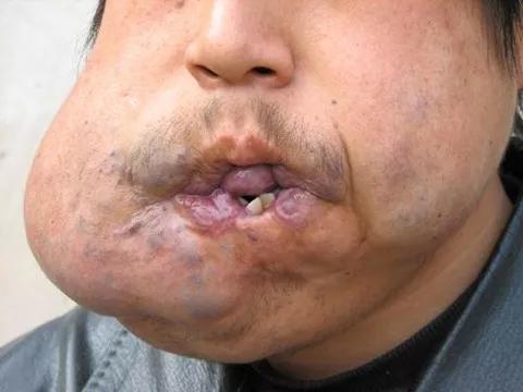 昆明血管瘤治疗