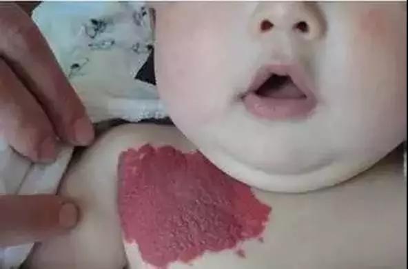 昆明如何判断血管瘤