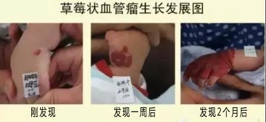 昆明血管瘤会消退吗