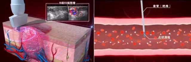 昆明治疗血管瘤的方法有哪些