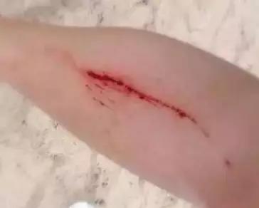 血管瘤该怎么护理