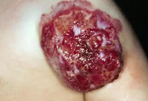 昆明血管瘤出血处理方法