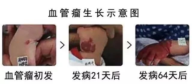 血管瘤生长图