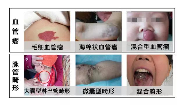 血管瘤的分类
