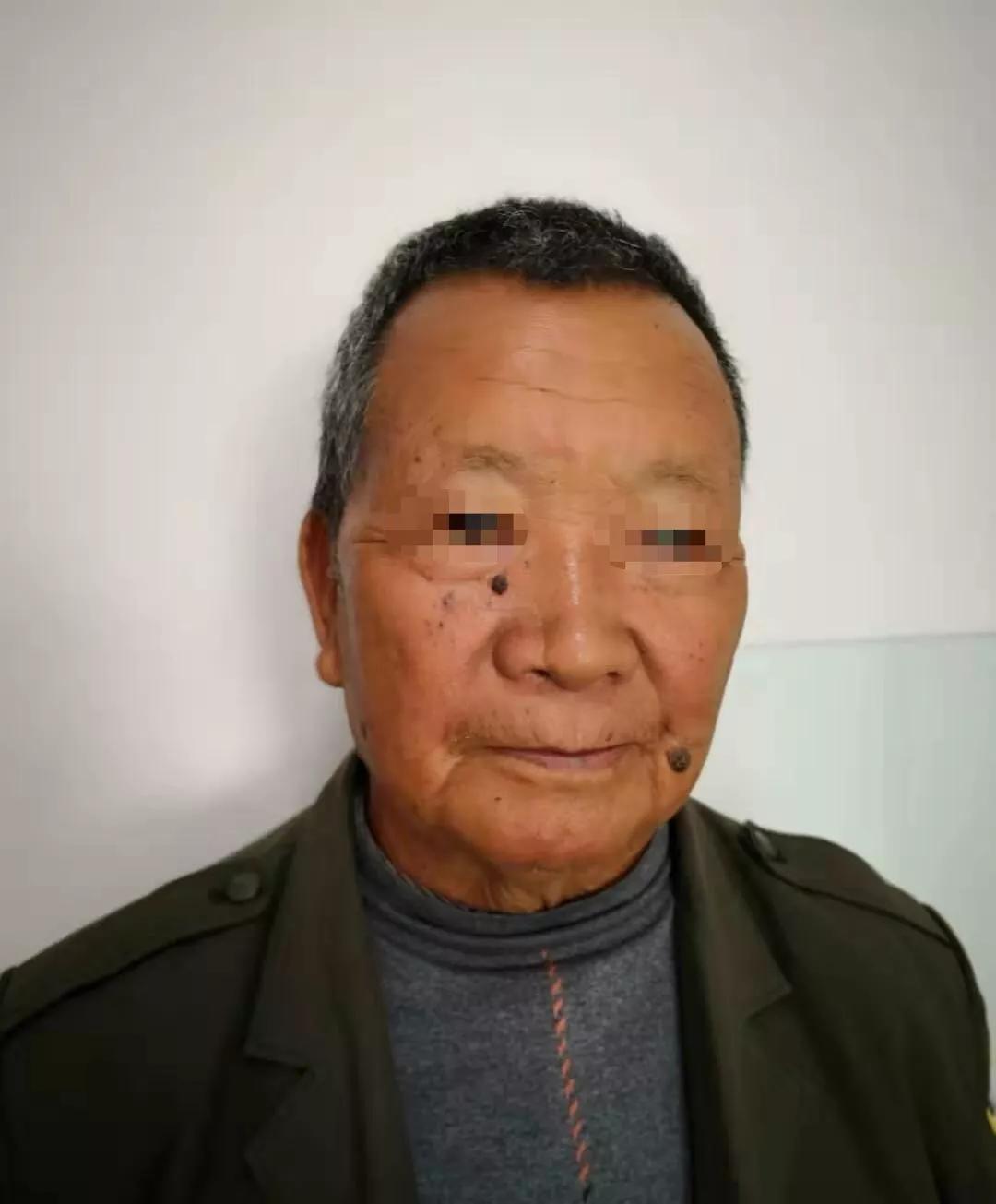 黑痣