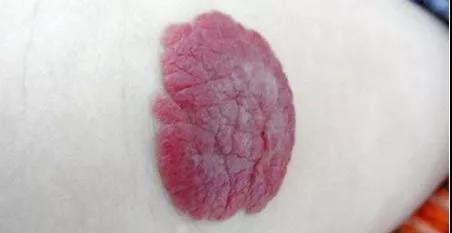 血管瘤涂了药膏能消除吗