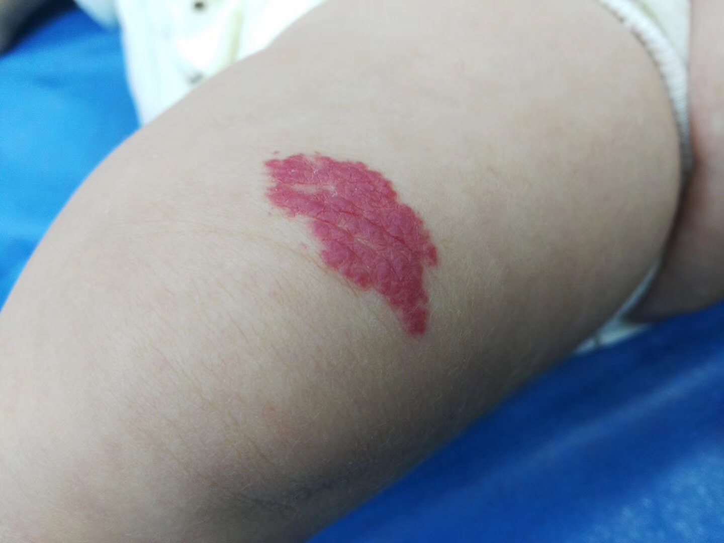 婴幼儿血管瘤病因