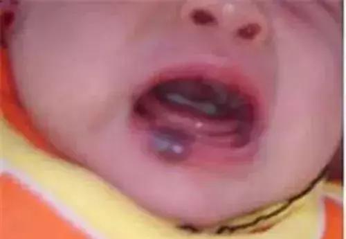 婴幼儿血管瘤症状